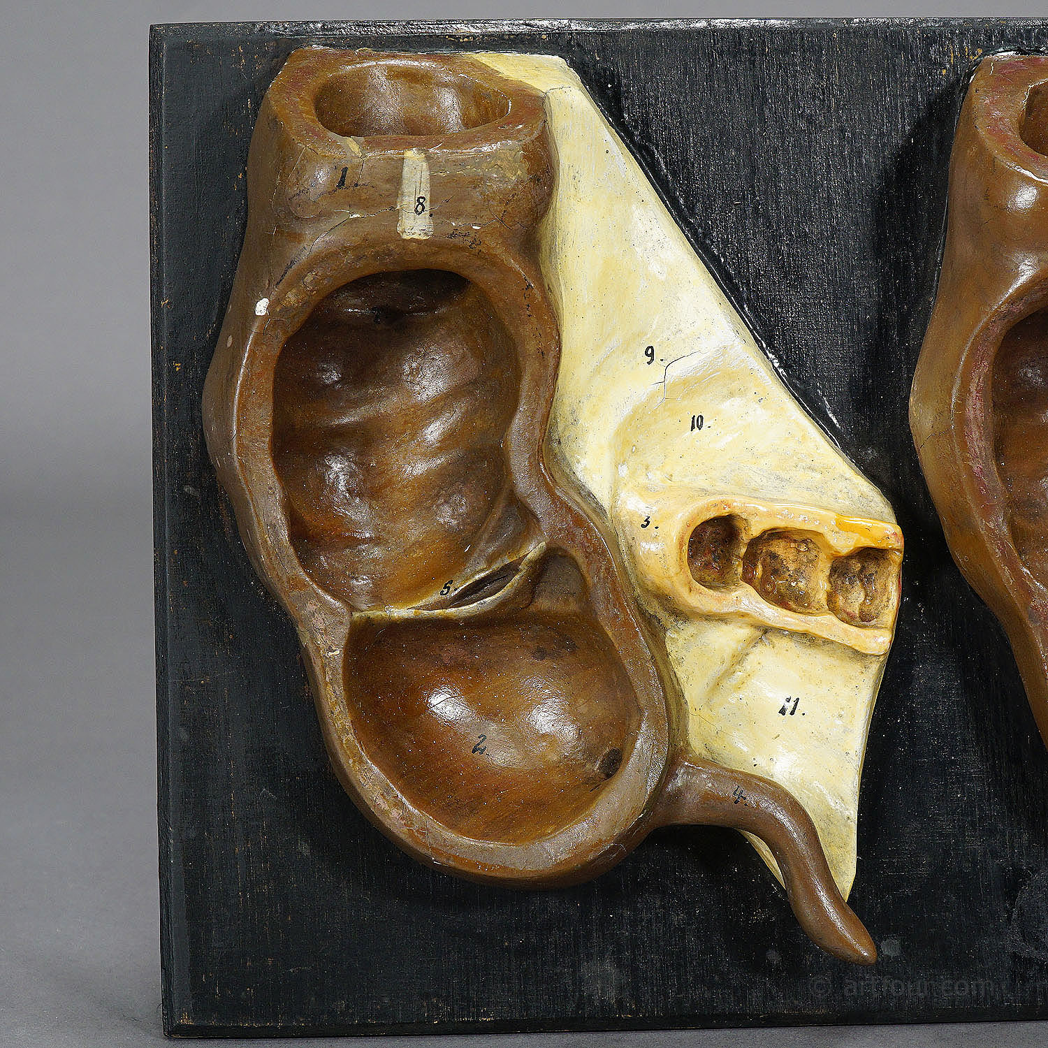Antique Teaching Model Stages of the Appendix, ca. 1900